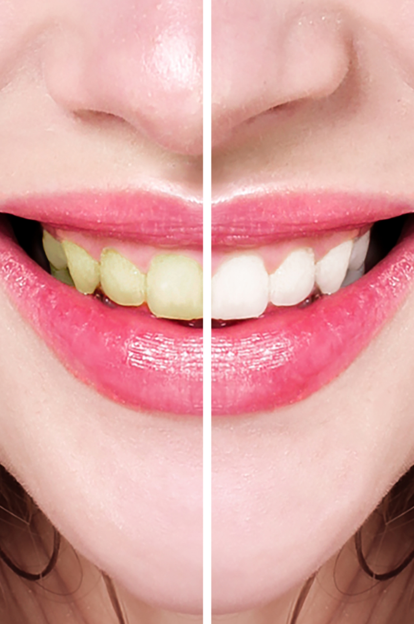 https://akyolmedical.com.tr/wp-content/uploads/2022/09/Bleaching-Dental-Whitening-1-850x1280.png