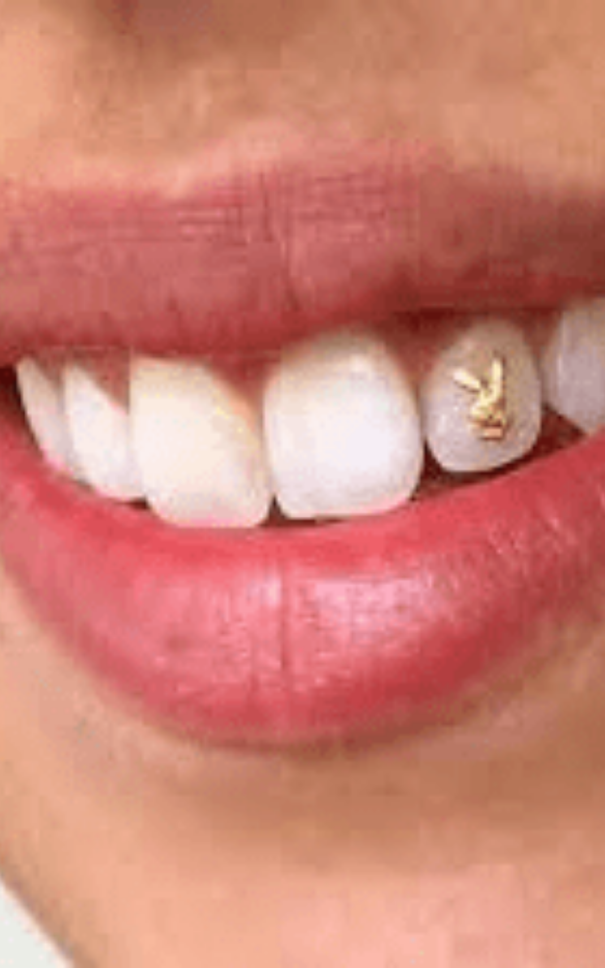 https://akyolmedical.com.tr/wp-content/uploads/2022/09/Dental-Grillz.png