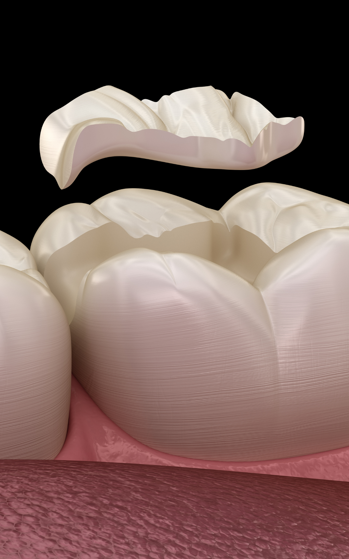 https://akyolmedical.com.tr/wp-content/uploads/2022/09/Inlay-Filling.png