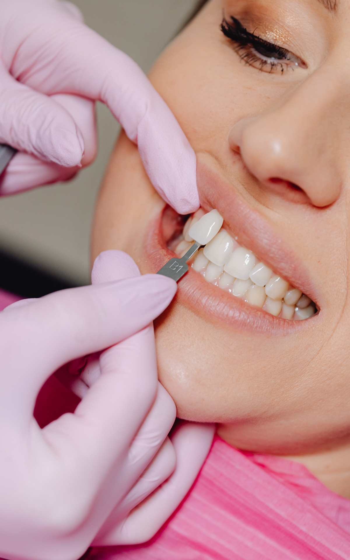 https://akyolmedical.com.tr/wp-content/uploads/2022/09/Laminate-Veneers.png