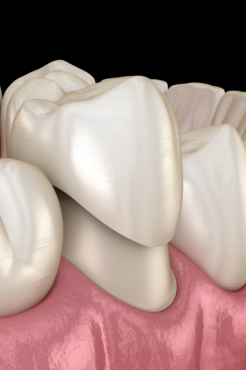 https://akyolmedical.com.tr/wp-content/uploads/2022/09/Onlay-Filling-850x1280.png
